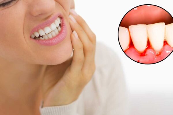 Gingivitis Treatment – Home Remedies That Work Wonders