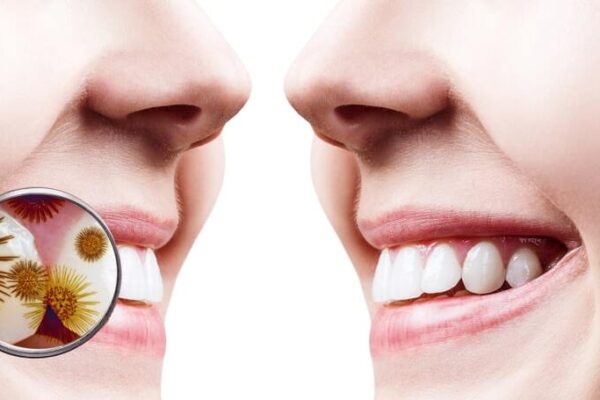 How to Get Relief from Tooth Abscess Pain Fast