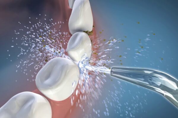 Will a Waterpik help with Receding Gums? Exploring the Benefits