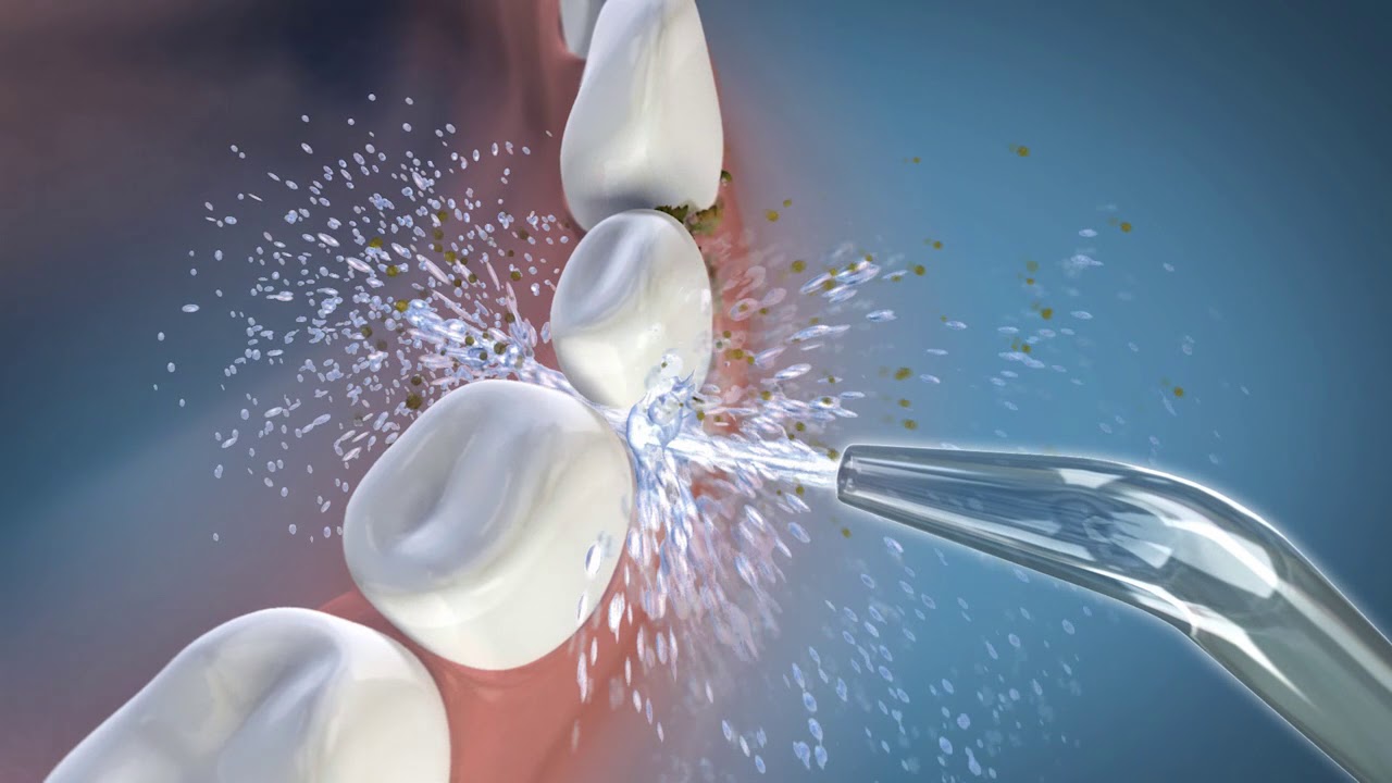 Will a Waterpik help with Receding Gums? Exploring the Benefits