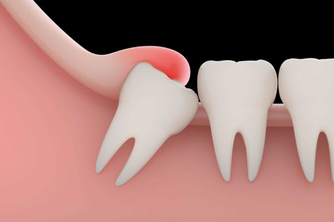 A Guide to Understanding Tooth Extraction Costs & Remedies