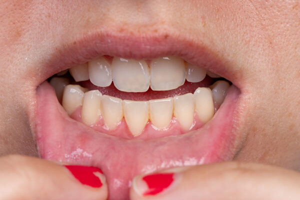 Combat Receding Gums: Use Oil Pulling for a Healthier Smile