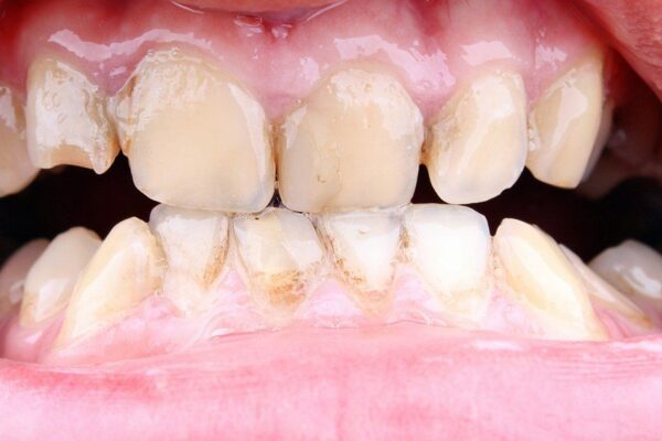 Cure Gum Disease without a Dentist: These Tips Will Help