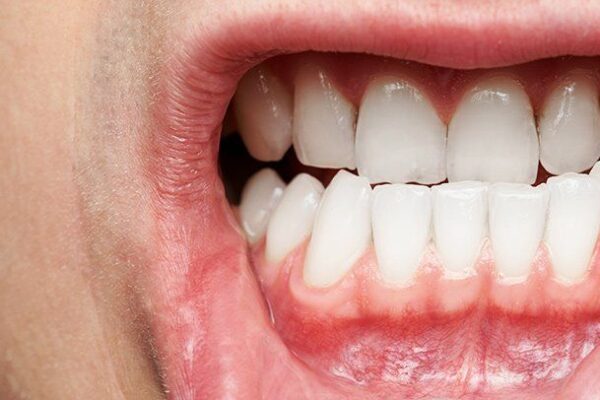 Dental Health: Identify Signs of Gum Disease & Get Treatment