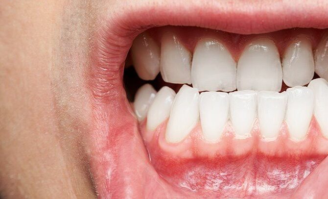 Dental Health: Identify Signs of Gum Disease & Get Treatment