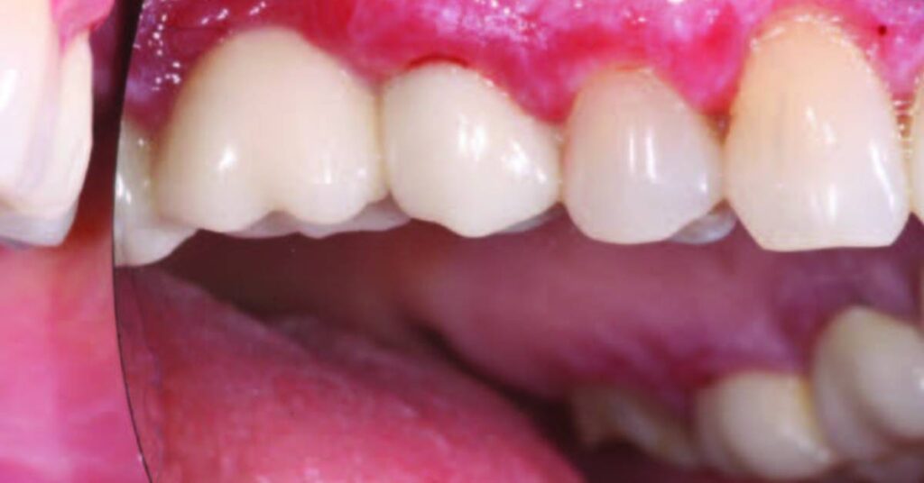 Discover Natural Remedies to Overcome Gingivitis: An Overview