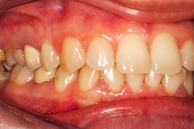 Discover Risk Factors, Prevention & Home Remedies for Gingivitis