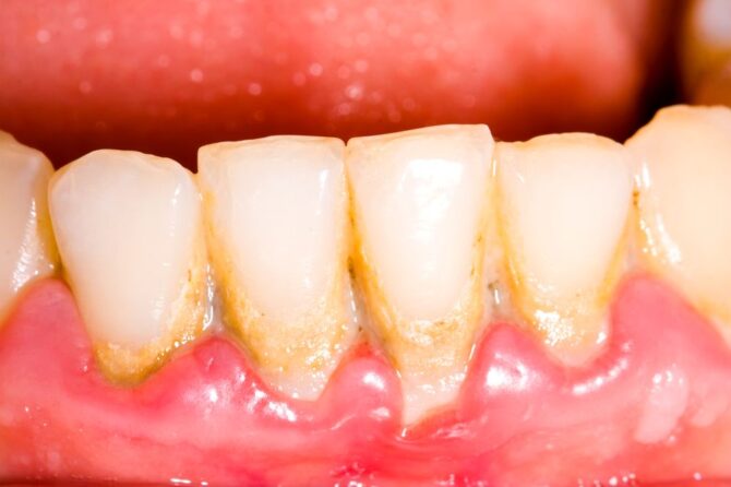 Fight Gum Disease & Regrow Gums Naturally with Diet & Oral Care