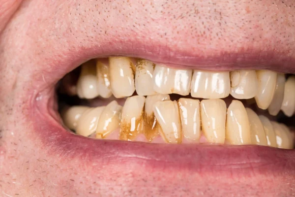 Gums Receding? Here’s How to Move Forward with Treatment