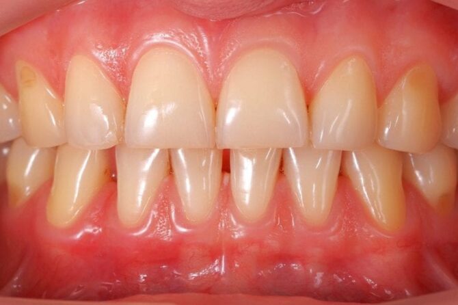 Prevent & Repair Receding Gums – Natural Solutions Here!