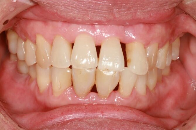 Gain Back Healthy Gums Through These Treatment Options