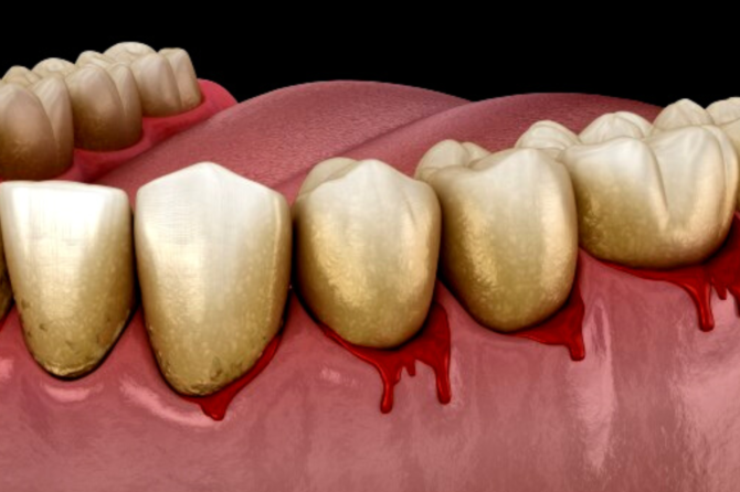 Say Goodbye to Sore Gums: Home Remedies, Diet & Lifestyle Changes