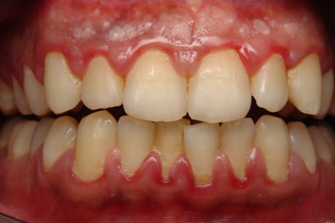 The Terrible Truth About Gingivitis: How to Spot it & Treat It