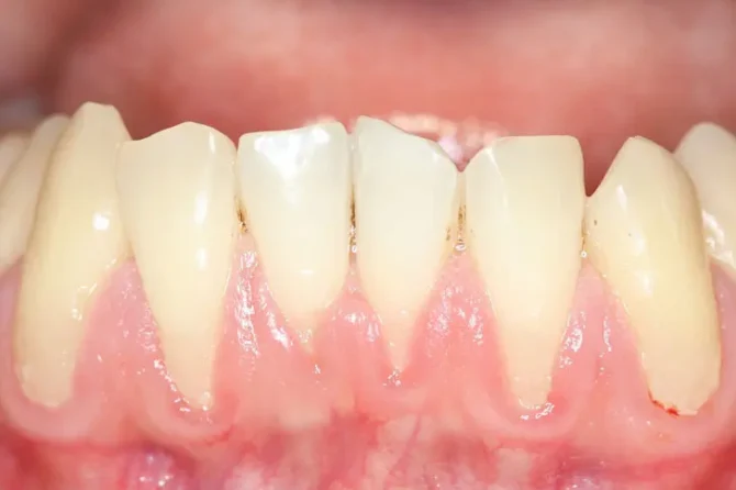 Tired of Receding Gums? Try These Special Techniques to Grow Gums