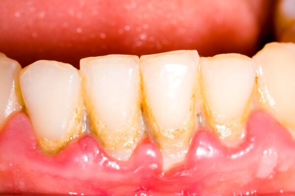 Uncover What Research Reveals About Early Stage Gum Disease & Treatment