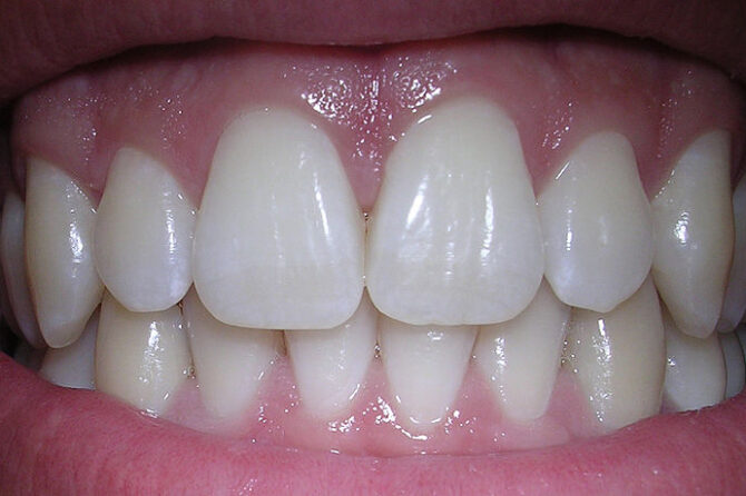 What You Need To Know About Gum Recession &  can Waterpik Cause Gum Recession