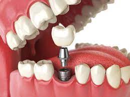 Secure Your Smile with an Affordable Implant Solution