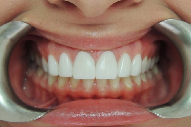 Receding Gums? Find Out How can Your gum Grow Back Healthy Gums Naturally