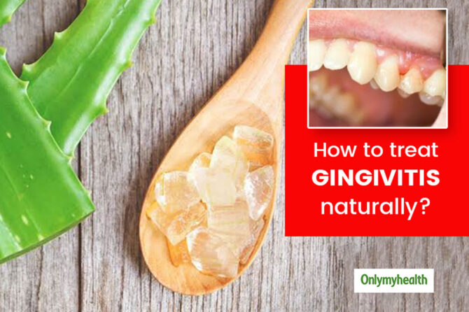 Treat Gingivitis With Home Remedies the Natural Way: Expert Tips on Home Remedies