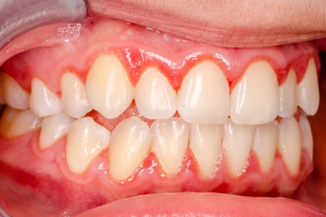 Combatting Gingivitis: Learn About Prevention & Maintenance