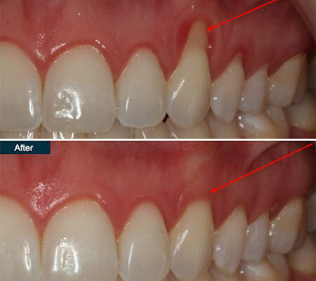 Trick to Treat: Learn How to Fix Gum Recession