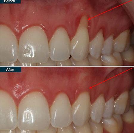 Trick to Treat: Learn How to Fix Gum Recession