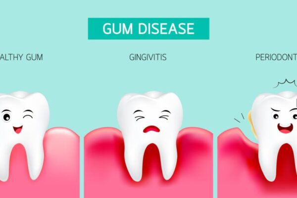 Simple Home Remedies to Help You Heal Gums