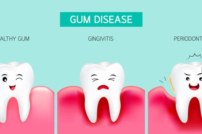 Simple Home Remedies to Help You Heal Gums