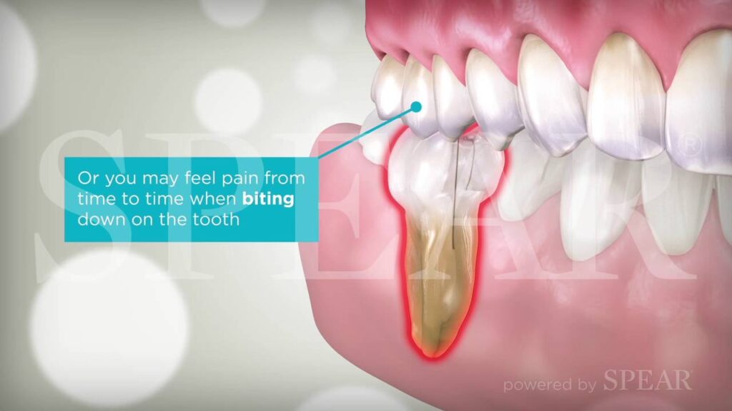 How to Fix Broken Teeth in Your Own Home