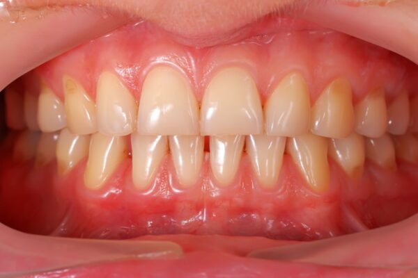 Turn Around Your Reversing Gum Disease: A Comprehension Guide