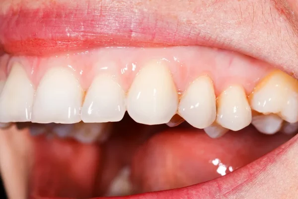 “Feeling healthy regrow gums”- 8 Foods That Help