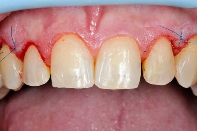  Gum Graft Cost Without Insurance