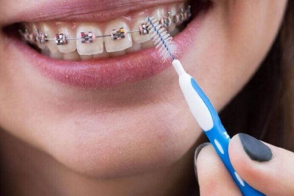  poor oral hygiene with braces