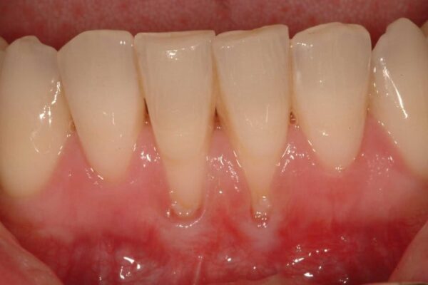 “Can Receding Gums Be Repaired?” Repair Your Gums Naturally and Fast with this Simple Trick!