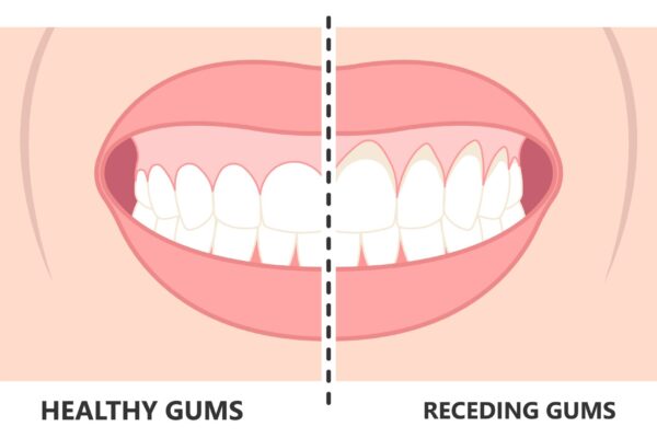 Signs of Receding Gums and How to Regrow Gums Naturally