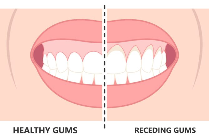 Signs of Receding Gums and How to Regrow Gums Naturally