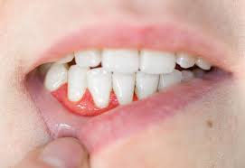   Tooth Abscess Treatment: 