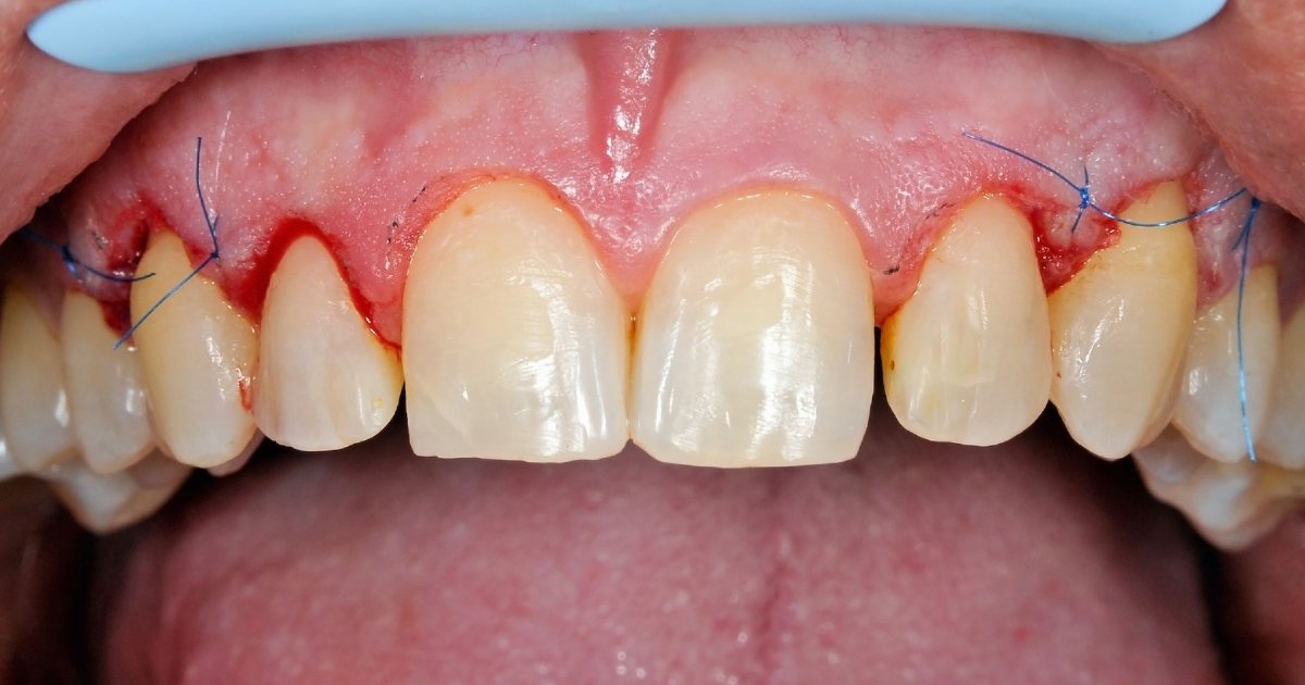 Gum Graft Surgery Cost What You Need to Know?