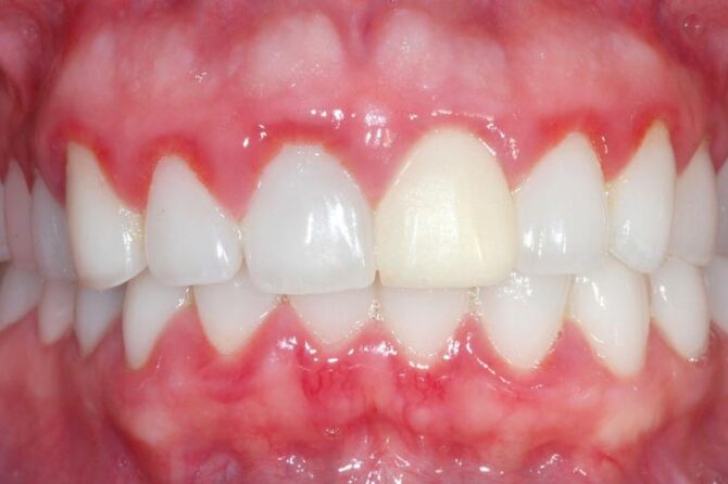 Home remedies for bleeding gums that work?