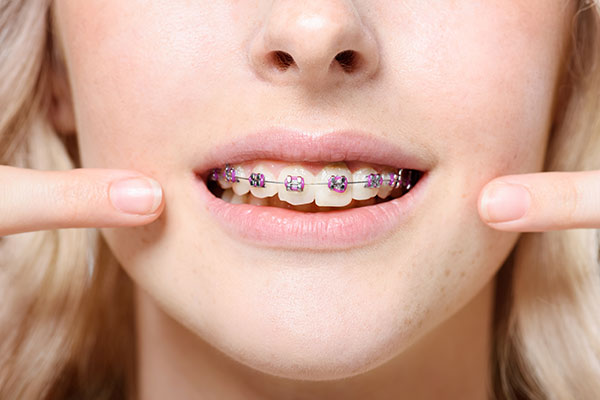 ‘Gum Pain With Braces?’ Here’s how to find relief